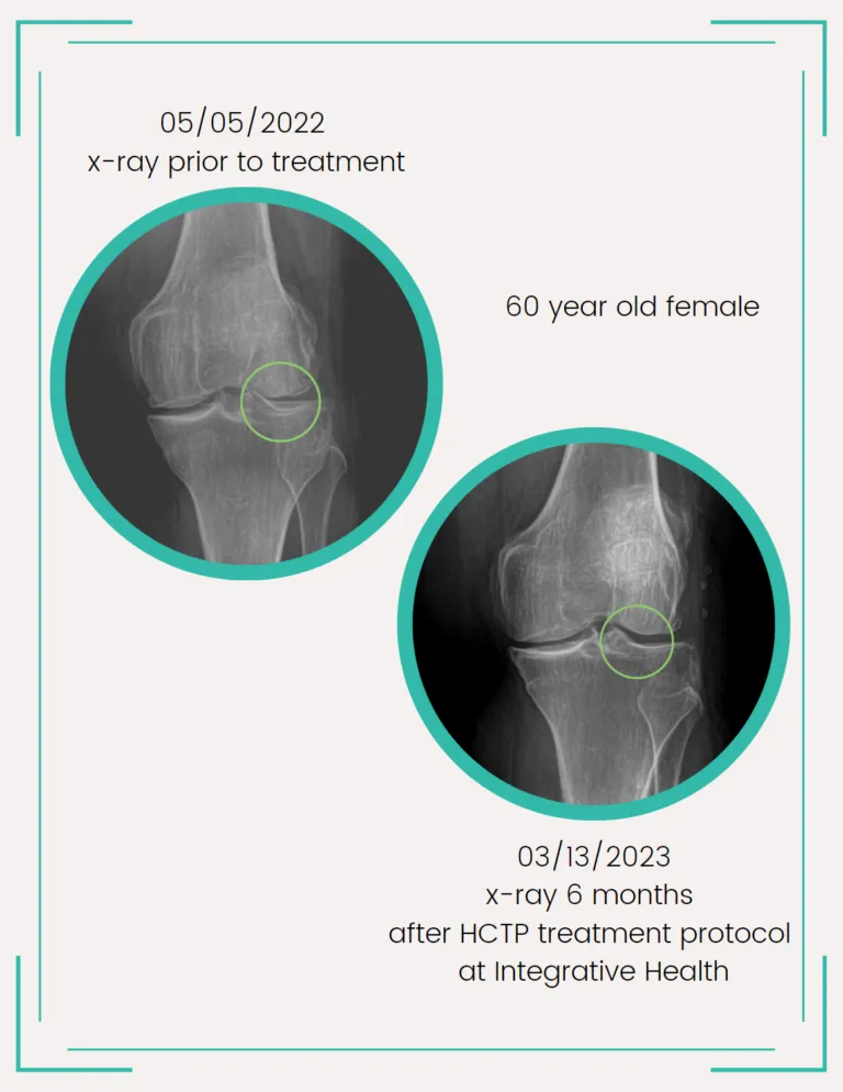 before and after xrays