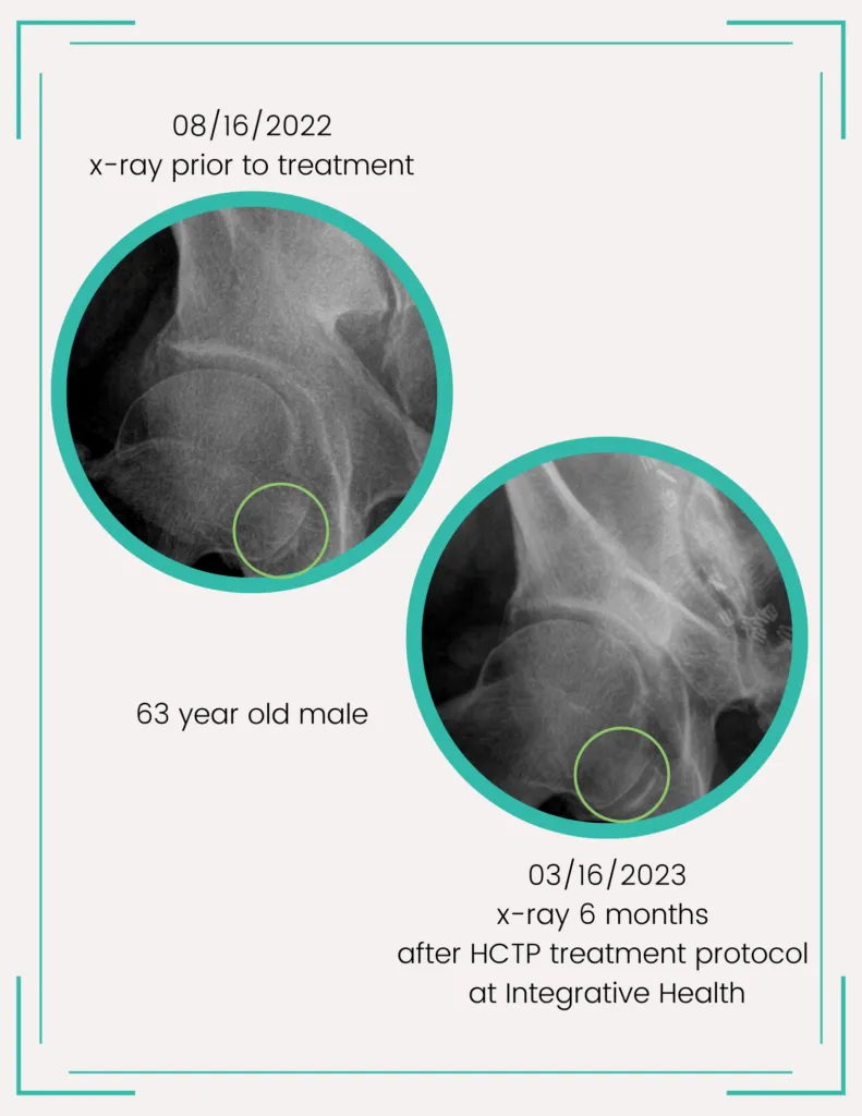 Hip Xray