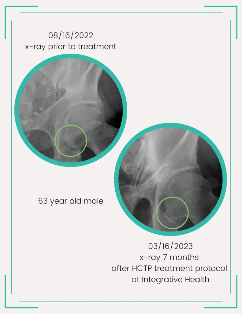 right hip xray